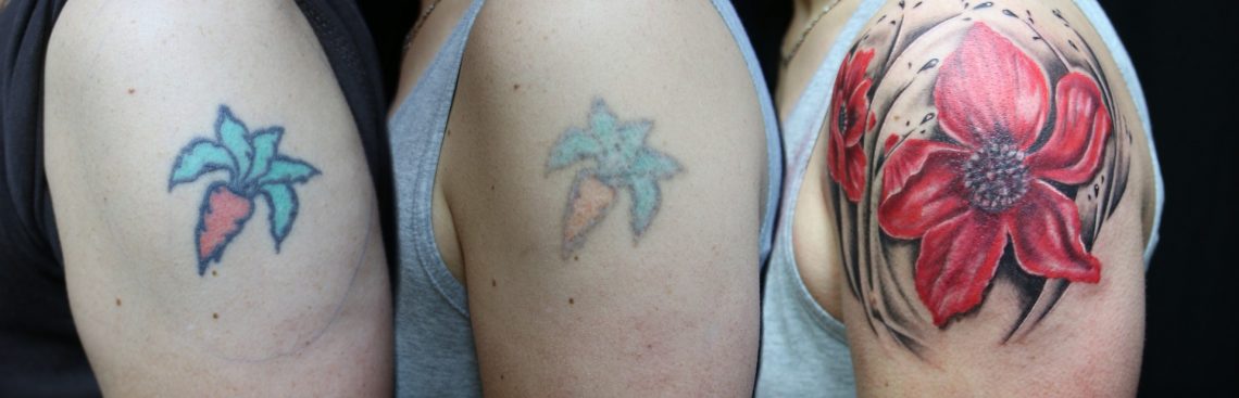 Czy usuwanie tatuażu jest skuteczne i bezpieczne?